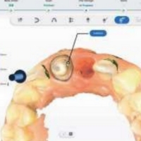 Shining 3D Aoralscan Elite - Contrôle des contre-dépouilles